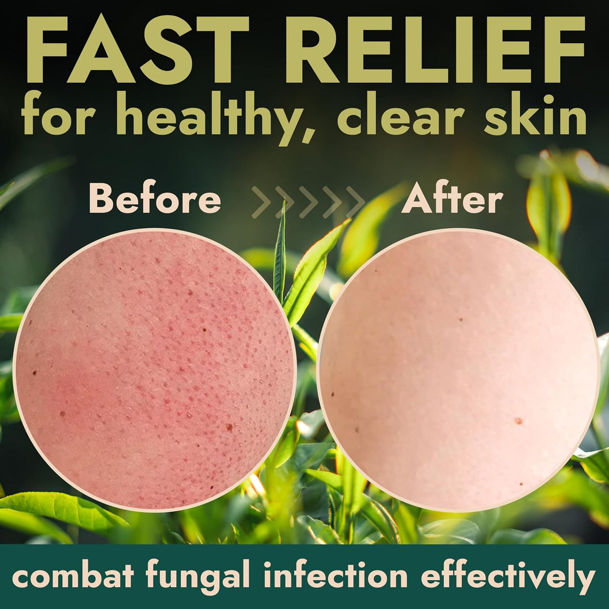 Antifungal Body Scrub with Tea Tree Oil Soothes Itchy Skin & Rashes