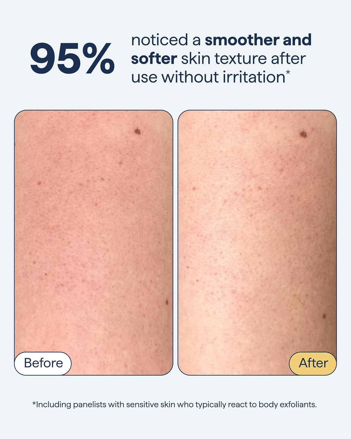 REMEDY KP Exfoliating Body Scrub, with Fine Sugar